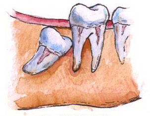 Зубная боль при прорезывании зуба мудрости